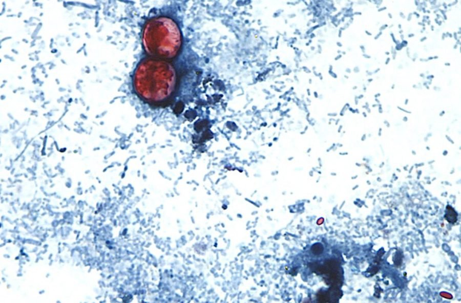 You are currently viewing More than 18,200 cyclosporiasis cases now suspected in US: Where it’s getting worse