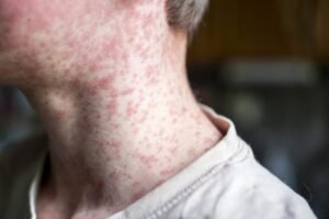 Read more about the article US exceeds measles cases in all of 2025 by July 2026