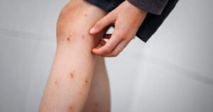 Read more about the article Edmonton kids experiencing ‘skeeter syndrome’ this wet, hot summer