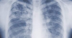 Read more about the article Are you underestimating mold-related illness? What U.S. study says
