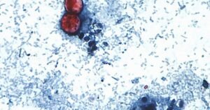 Read more about the article Michigan reports first U.S. deaths from multi-state cyclosporiasis outbreak